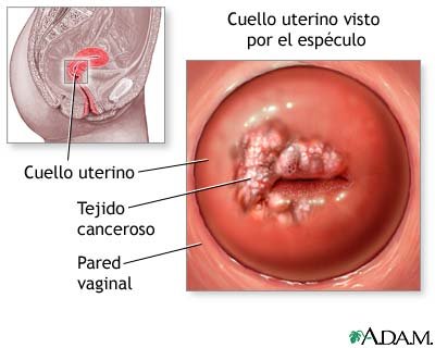condilomas acuminados fotos condilomas acuminados fotos